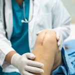 Asian elderly old woman patient show her scars surgical knee joint replacement Suture wound surgery